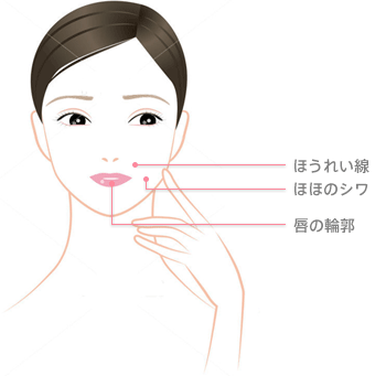 ヒアルロン酸の主な注入部位